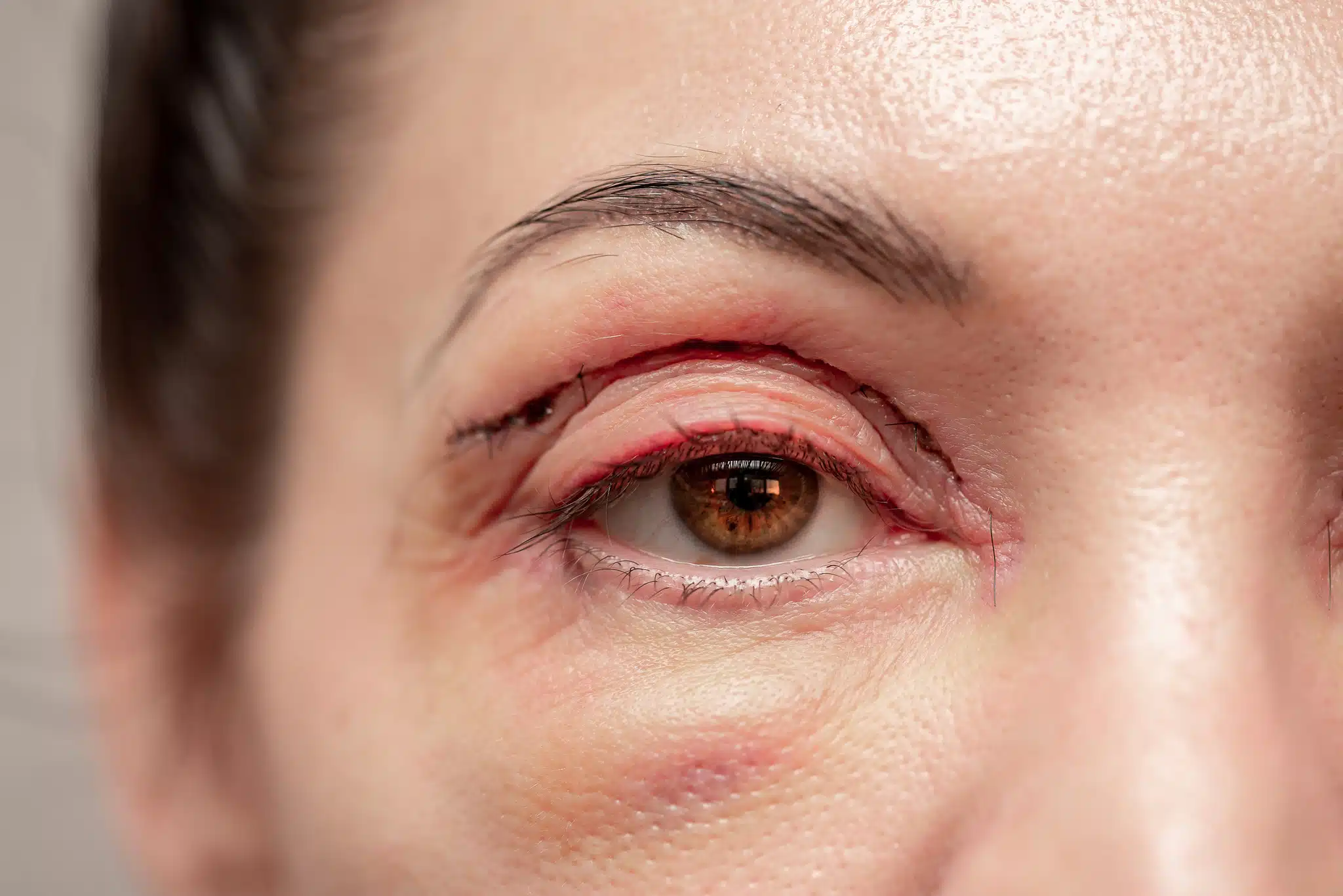 Blépharoplastie et regard